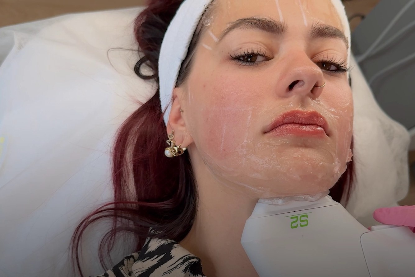 HIFU-Behandlung unter dem Kinn bei Skinbar Vienna