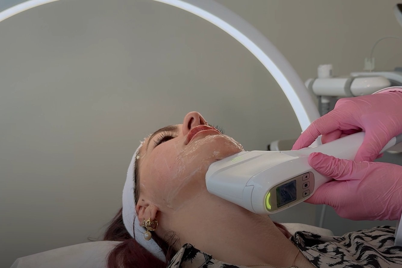 HIFU-Behandlung an der Kinnlinie bei Skinbar Vienna